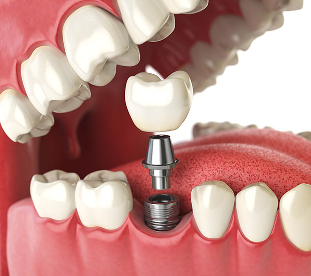 Englewood Will I Need a Bone Graft for Dental Implants