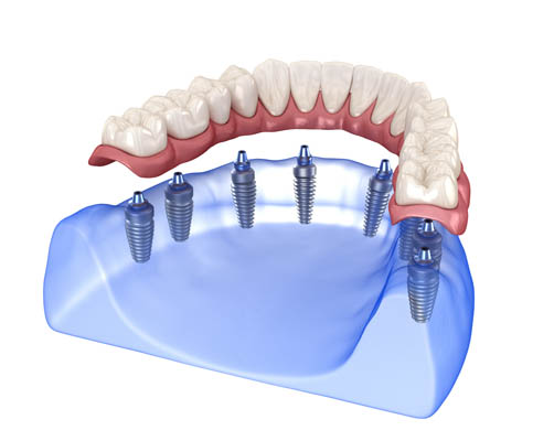 How Many Implants Are Needed For Implant Supported Dentures?