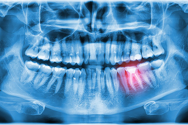 When Would Oral Surgery Be Necessary?